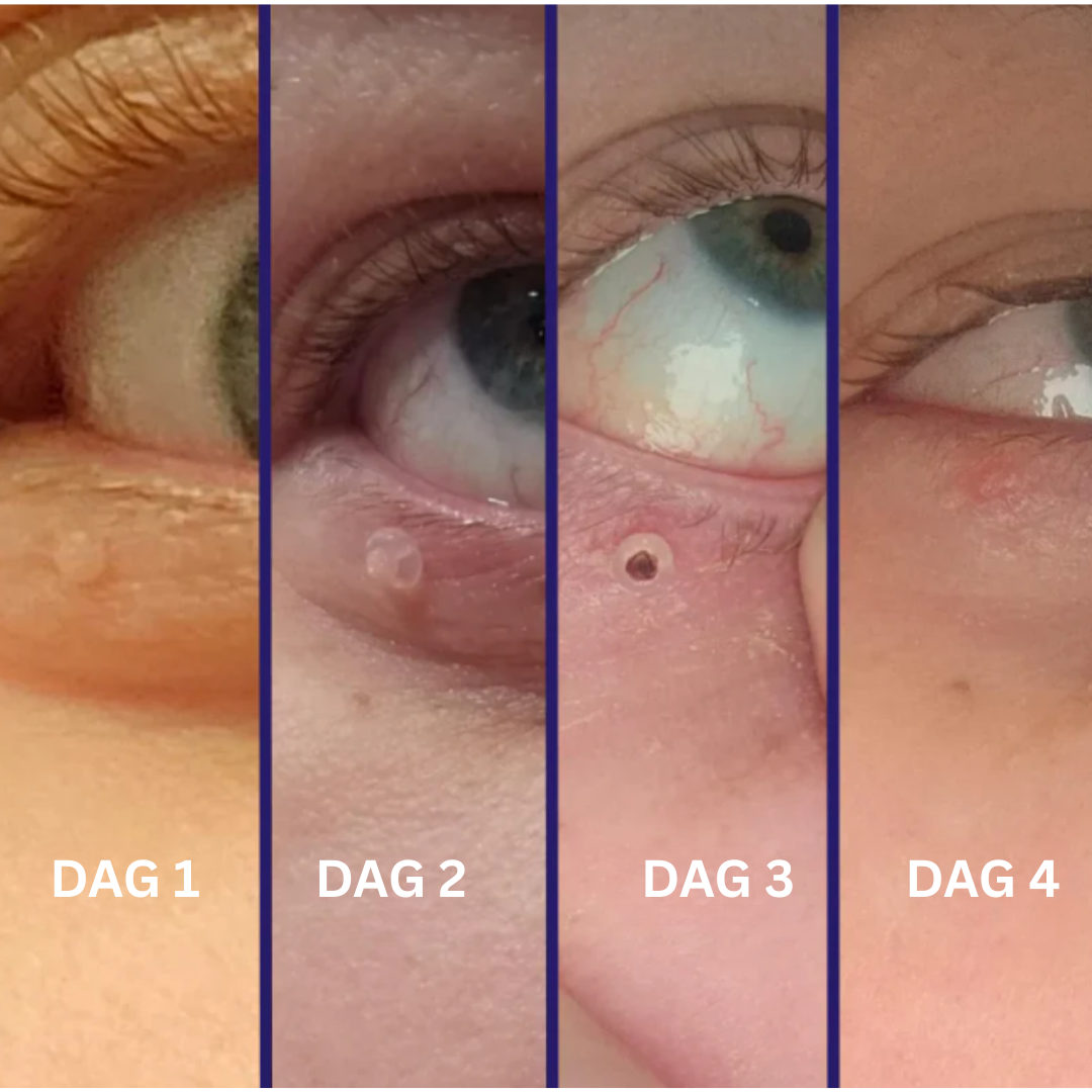 SkinClearer - Smärtfri bortagning av hudflikar